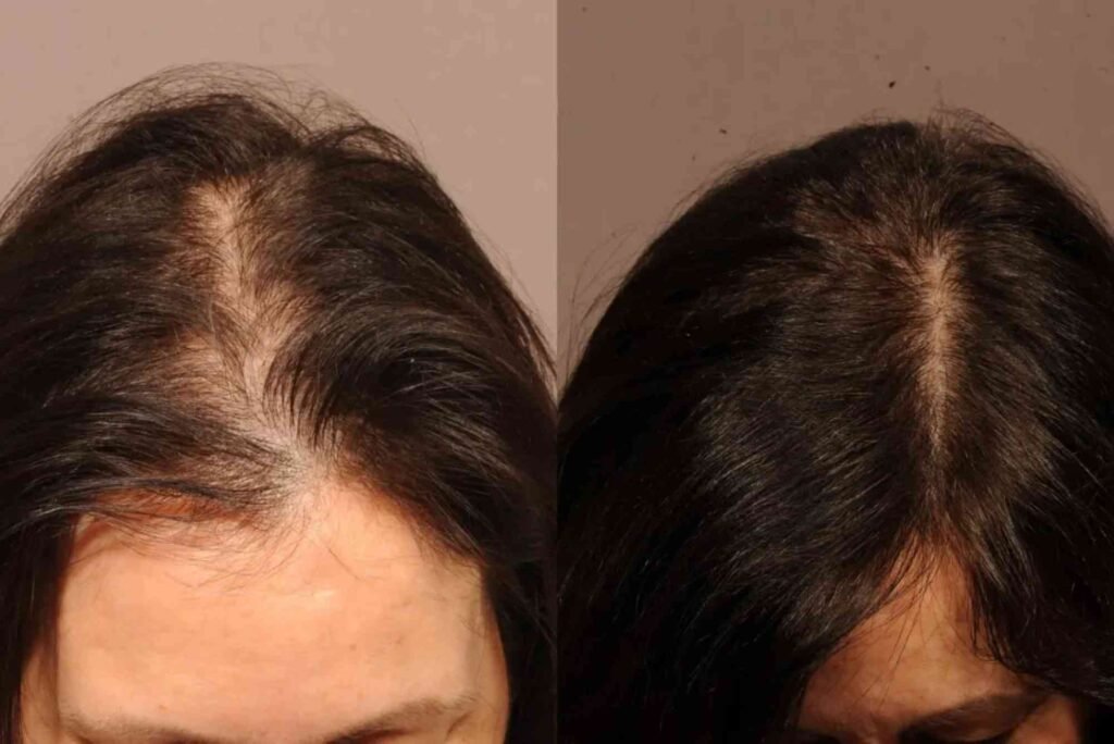 Hair Transplant Turkey